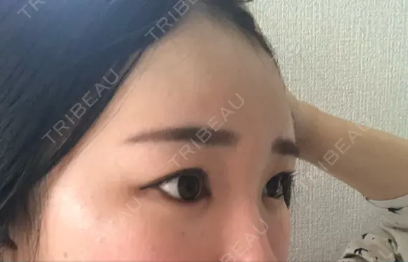ヒアルロン酸注入（額） 東京イセアクリニック DAY 2 メイン用