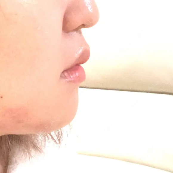 バッカルファット除去 / セットバック 銀座フェイスクリニック（小顔整形・輪郭整形專門） DAY 64 メイン用