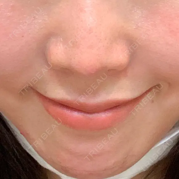 肌ヒアルロン酸注入（たるみ・シワ改善） 水の森美容クリニック 大阪梅田院 AFTER メイン用