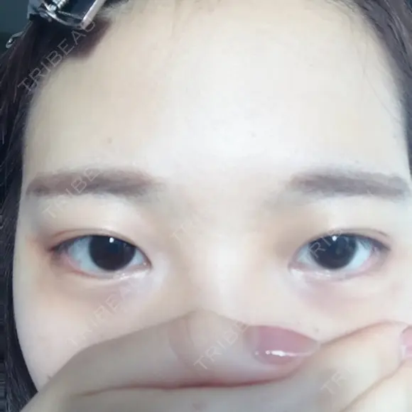 二重埋没 かわた美容クリニック AFTER メイン用