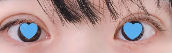 二重切開 / 目元修正 水の森美容クリニック 名古屋院 DAY 36 メイン用