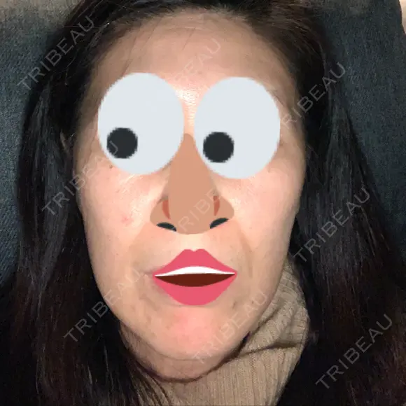 ボトックス（エラ・小顔） 湘南美容クリニック 藤沢院 DAY 19 メイン用