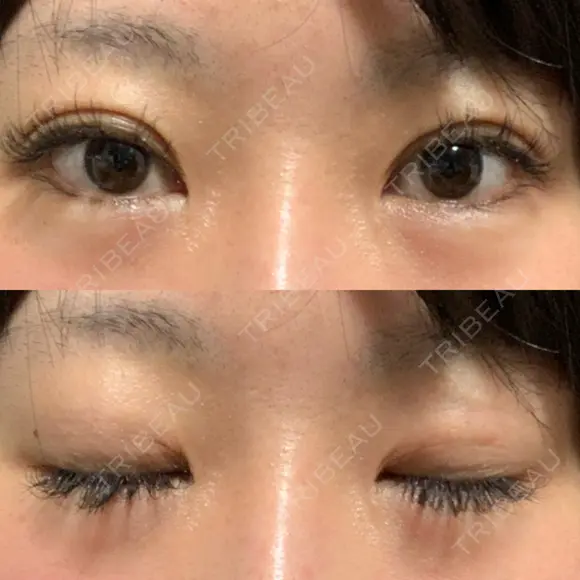 二重埋没 湘南美容クリニック Regno 銀座院 DAY 25 メイン用