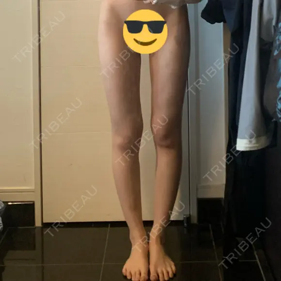 脂肪吸引（脚） / 豊胸（脂肪注入） / 脂肪注入（額） 湘南美容クリニック 新橋銀座口院 AFTER メイン用