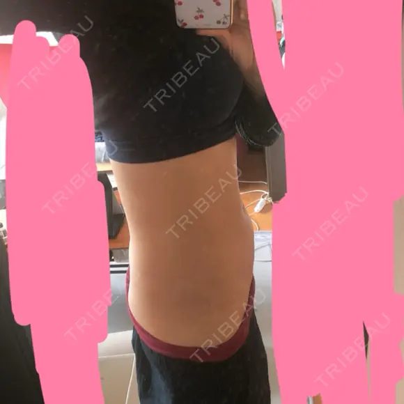 脂肪吸引（お腹） / その他（ボディ） ザ・セロイ美容外科医院 DAY 173 メイン用