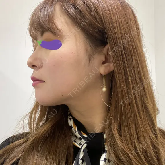 脂肪吸引（顔） 表参道スキンクリニック 表参道院 DAY 125 メイン用