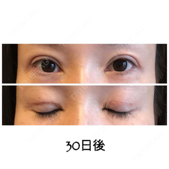二重切開 / 目元修正 ビスポーククリニック 福岡院 DAY 30 メイン用