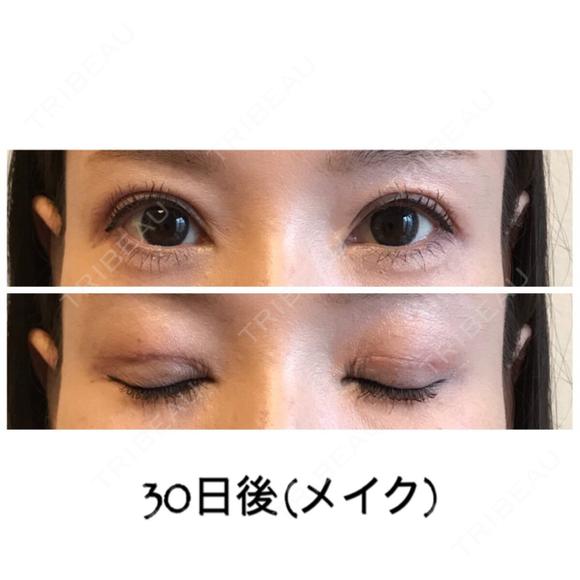 二重切開 / 目元修正 ビスポーククリニック 福岡院 DAY 30 メイン用