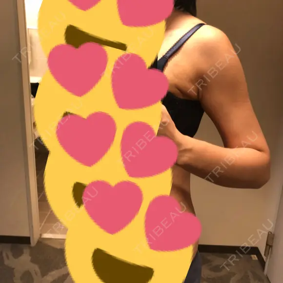 脂肪吸引（二の腕） ラインカルチャークリニック DAY 163 メイン用