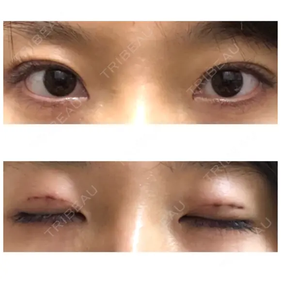 二重埋没 表参道スキンクリニック 表参道院 DAY 0 メイン用