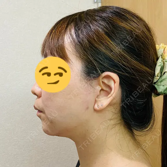 切開リフト 石倉クリニック 水戸院 DAY 74 メイン用