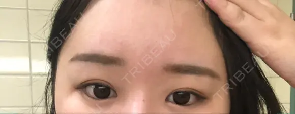 ヒアルロン酸注入（額） 東京イセアクリニック DAY 4 メイン用