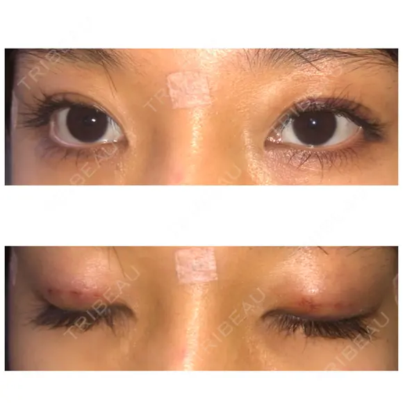 二重埋没 表参道スキンクリニック 表参道院 DAY 1 メイン用