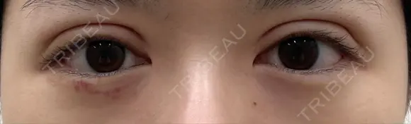 二重切開 恵聖会クリニック 心斎橋院 DAY 14 メイン用