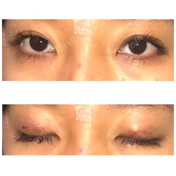 二重埋没 表参道スキンクリニック 表参道院 DAY 2 メイン用