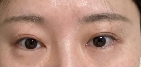 眼瞼下垂（切開） くさのたろうクリニック DAY 47 メイン用