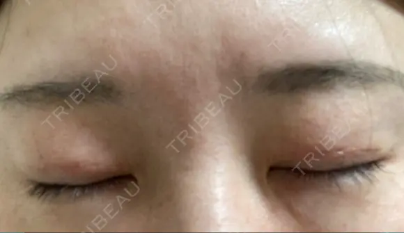 眼瞼下垂（切開） くさのたろうクリニック DAY 47 メイン用