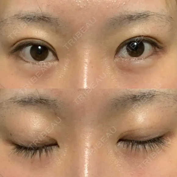 二重埋没 湘南美容クリニック Regno 銀座院 AFTER メイン用