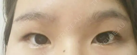 眉下切開 湘南美容クリニック 高田馬場院 DAY 36 メイン用
