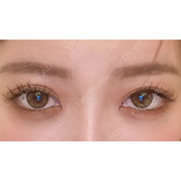 二重切開 / タレ目形成・グラマラスライン（切開） ハナキクリニック DAY 62 メイン用