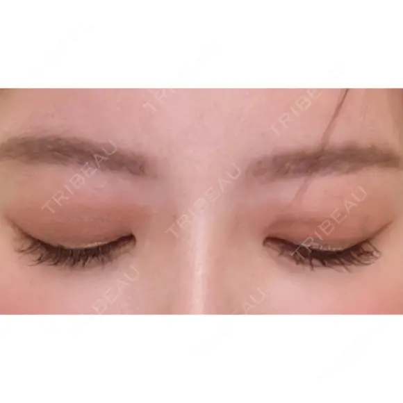 二重切開 / タレ目形成・グラマラスライン（切開） ハナキクリニック DAY 62 メイン用