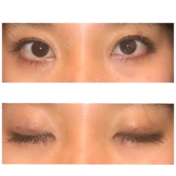 二重埋没 表参道スキンクリニック 表参道院 DAY 3 メイン用