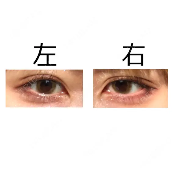 二重埋没 共立美容外科 大宮院 DAY 2 メイン用