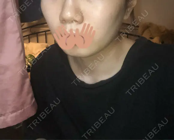 糸リフト / バッカルファット除去 / ボトックス（エラ・小顔） / ヒアルロン酸注入（頬） 湘南美容クリニック 横浜院 DAY 10 メイン用