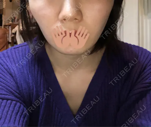 糸リフト / バッカルファット除去 / ボトックス（エラ・小顔） / ヒアルロン酸注入（頬） 湘南美容クリニック 横浜院 DAY 22 メイン用