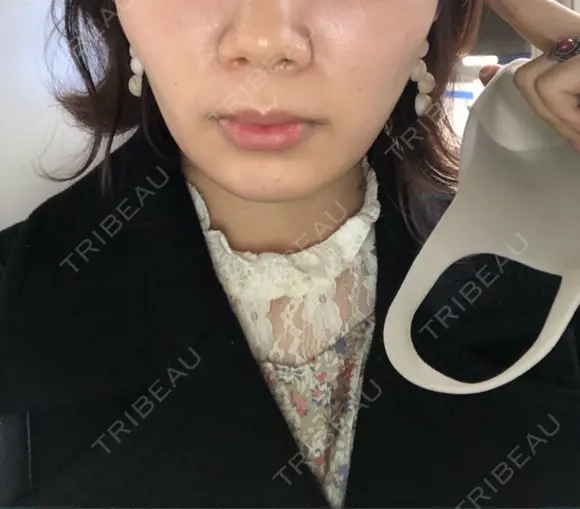 糸リフト / バッカルファット除去 / ボトックス（エラ・小顔） / ヒアルロン酸注入（頬） 湘南美容クリニック 横浜院 DAY 26 メイン用