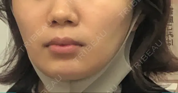 糸リフト / バッカルファット除去 / ボトックス（エラ・小顔） / ヒアルロン酸注入（頬） 湘南美容クリニック 横浜院 DAY 26 メイン用