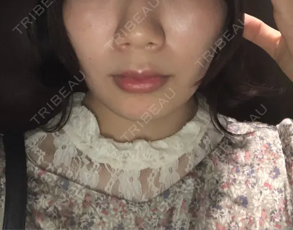 糸リフト / バッカルファット除去 / ボトックス（エラ・小顔） / ヒアルロン酸注入（頬） 湘南美容クリニック 横浜院 DAY 26 メイン用