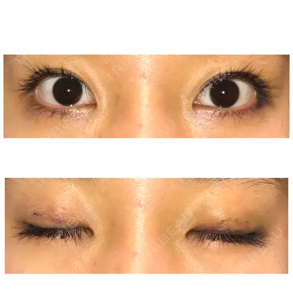 二重埋没 表参道スキンクリニック 表参道院 DAY 4 メイン用