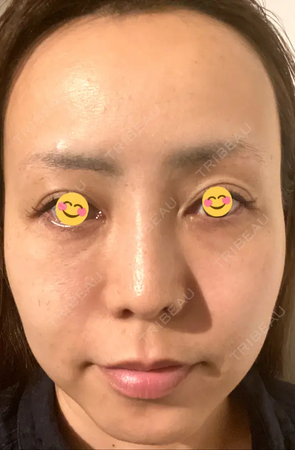クマ治療 / 再生医療 / PRP皮膚再生療法 銀座よしえクリニック 銀座院 DAY 29 メイン用