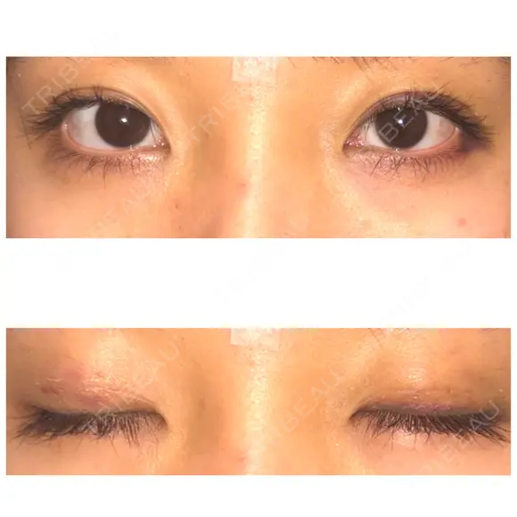 二重埋没 表参道スキンクリニック 表参道院 DAY 6 メイン用