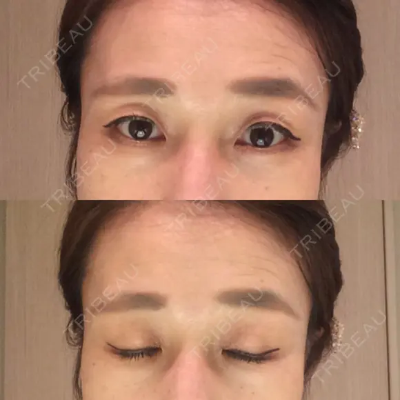 目尻切開 湘南美容クリニック 秋葉原院 DAY 39 メイン用