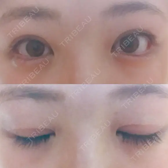 二重切開 / 眼瞼下垂（切開） / 目尻切開 ジュエリー美容外科 DAY 34 メイン用