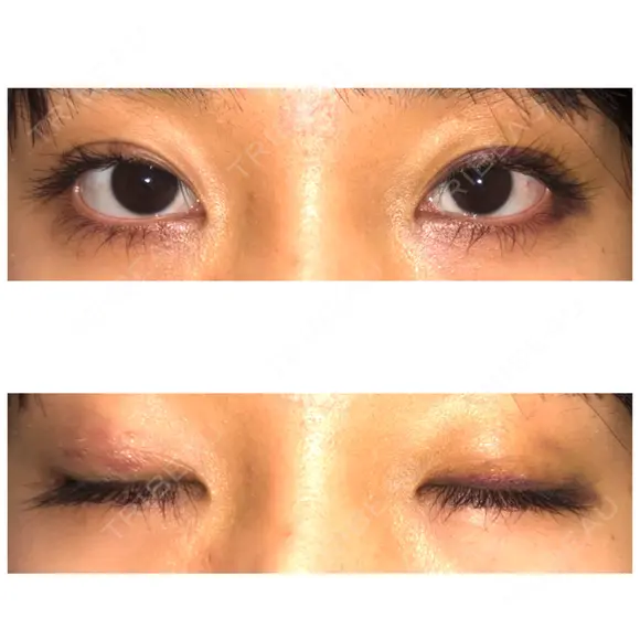 二重埋没 表参道スキンクリニック 表参道院 DAY 6 メイン用