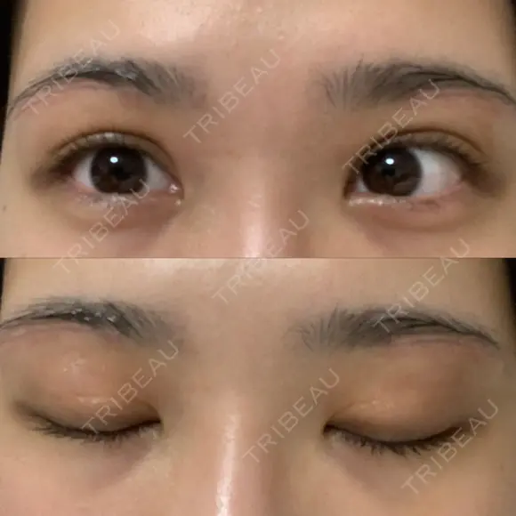 上まぶたの脂肪取り / 眉下切開 WOM CLINIC GINZA （ワム クリニック ギンザ） DAY 16 メイン用