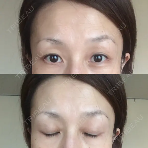 目尻切開 湘南美容クリニック 秋葉原院 DAY 41 メイン用