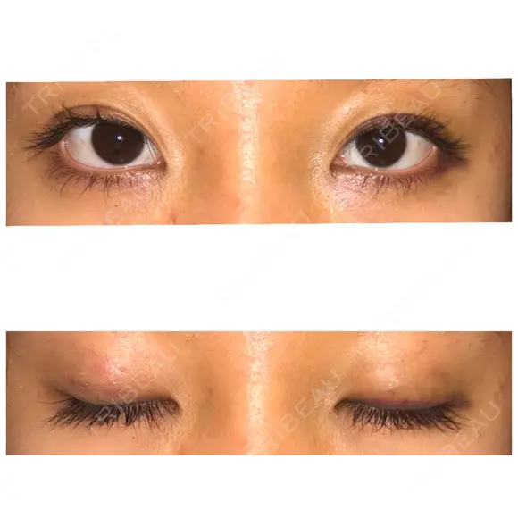 二重埋没 表参道スキンクリニック 表参道院 DAY 7 メイン用