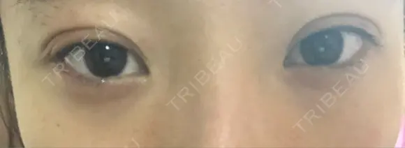 二重埋没 湘南美容クリニック 静岡院 DAY 11 メイン用