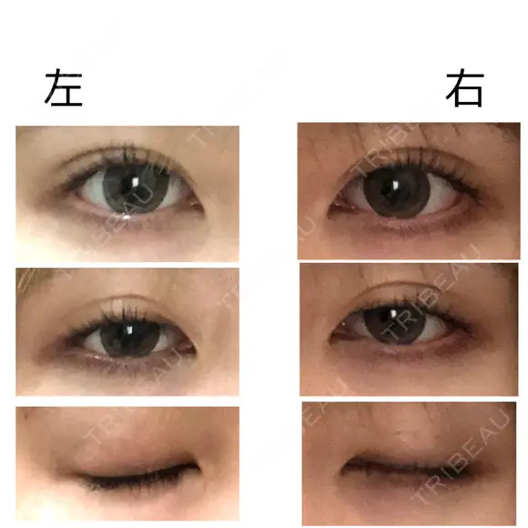 二重埋没 共立美容外科 大宮院 DAY 7 メイン用