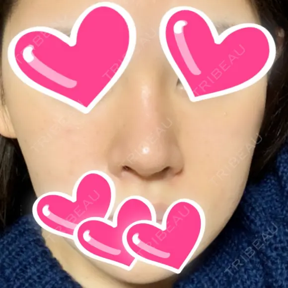 隆鼻術 / 鼻尖形成（切開） / 鼻中隔延長（切開） / 小鼻縮小（切開） / 眉間プロテーゼ ラミチェ美容整形外科 AFTER メイン用