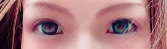 二重埋没 メディカルビューティセンター DAY 6 メイン用