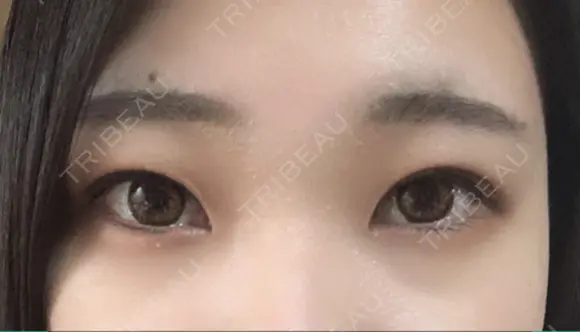 自然癒着法 マーブル美容整形外科 DAY 82 メイン用