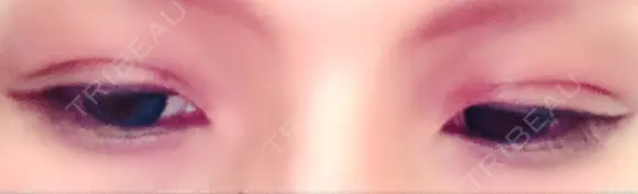 二重埋没 メディカルビューティセンター DAY 8 メイン用