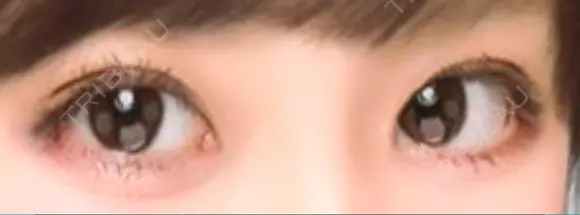 二重埋没 表参道スキンクリニック 表参道院 AFTER メイン用