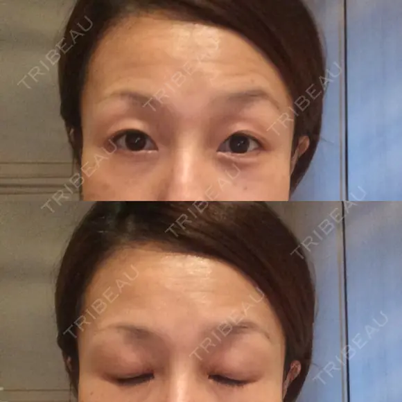 目尻切開 湘南美容クリニック 秋葉原院 DAY 44 メイン用