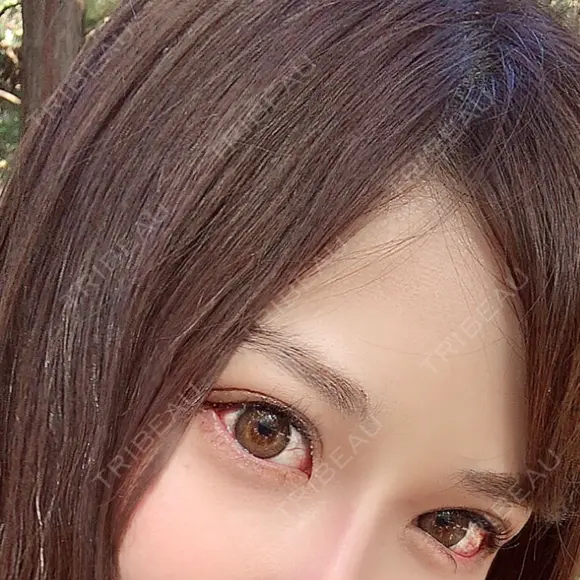 目尻切開 / タレ目形成・グラマラスライン（切開） / 目元修正 A CLINIC（エークリニック） 銀座院 DAY 8 メイン用